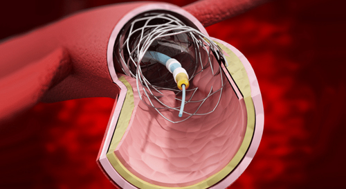 Vascular Interventions